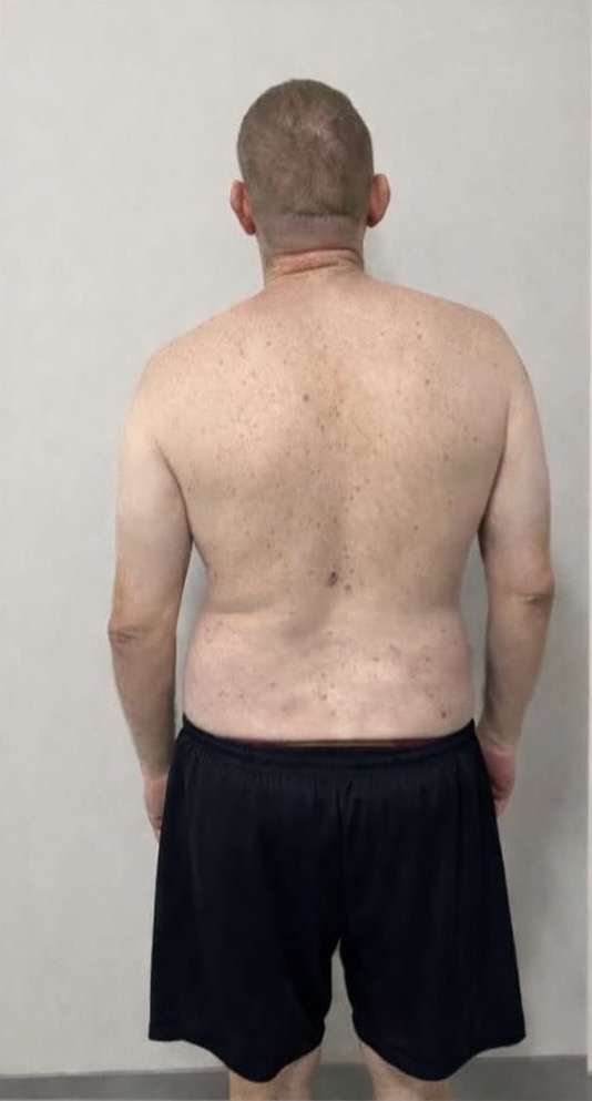 Registro postural ao final do tratamento conservador